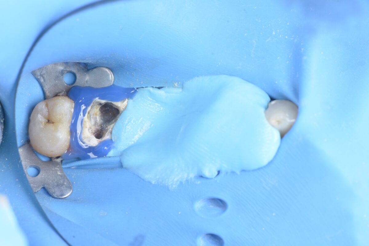 BLOG - Dr Brice Riera - EDTM - Endodontie 17e Paris