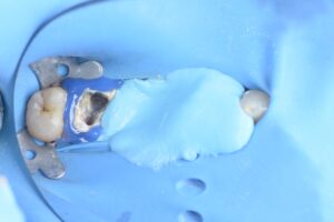 BLOG - Dr Brice Riera - EDTM - Endodontie 17e Paris