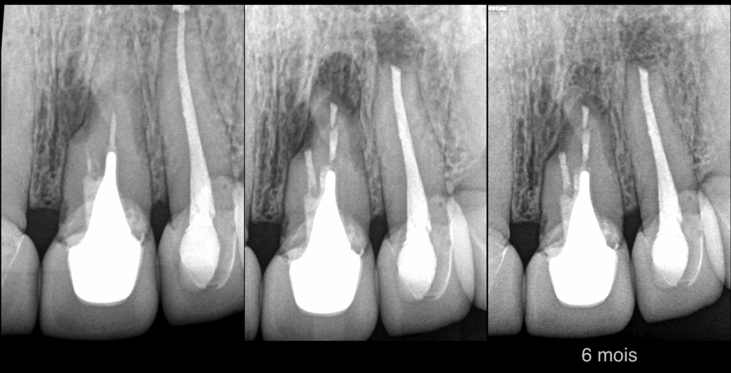 BLOG - Dr Brice Riera - EDTM - Endodontie Paris - cas 21 22 -3