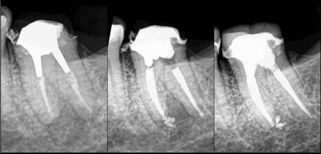BLOG - Dr Brice Riera - EDTM - Endodontie - controle a un an
