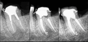 BLOG - Dr Brice Riera - EDTM - Endodontie - controle a un an