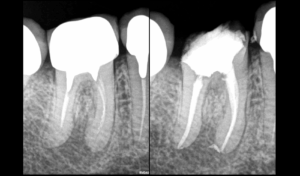 BLOG - Dr Brice Riera - EDTM - lentulo fracture en mesial