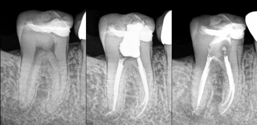 BLOG - Dr Brice Riera - Endodontie - Diagnostic 85 90 pourcent - Cas de cicatrision osseuse en distal non satisfaisante