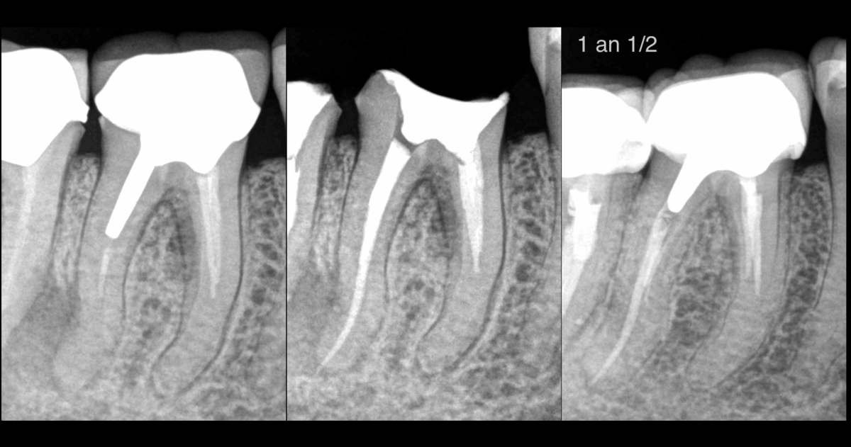 BLOG - Dr Brice Riera - Endodontie - traitement 46 et 47