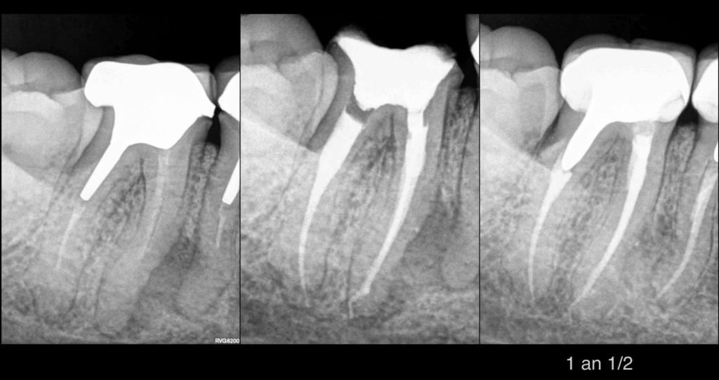 BLOG - Dr Brice Riera - Endodontie - traitement 46 et 47