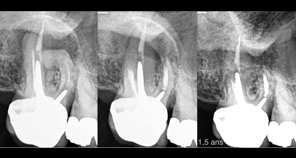 BLOG - Dr Brice Riera - Endodontiste - EDTM - Cas 17