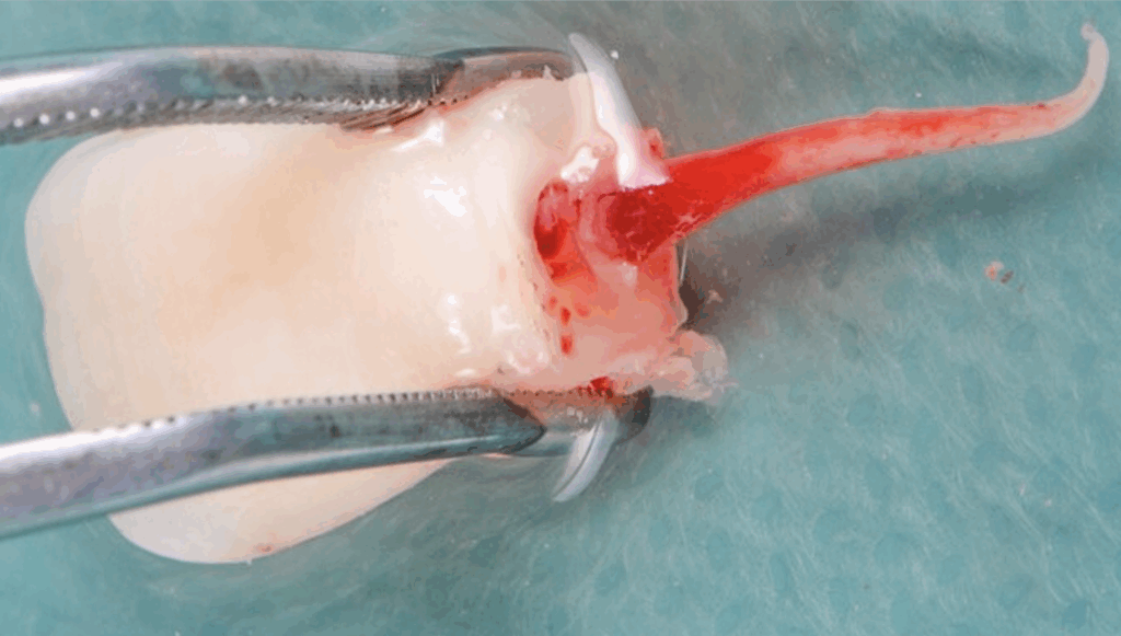 BLOG - Dr Brice Riera - Endodontiste - EDTM - pulpe