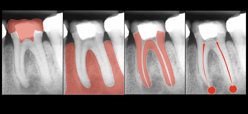 BLOG - Dr Brice Riera - pronostic global de la dent - endodontie