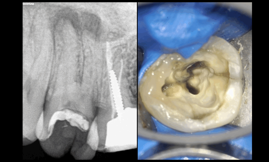 BLog - Dr Brice RIera - EDTM - Cabinet 17e arrondissement Paris - découverte felure en cours de traitement