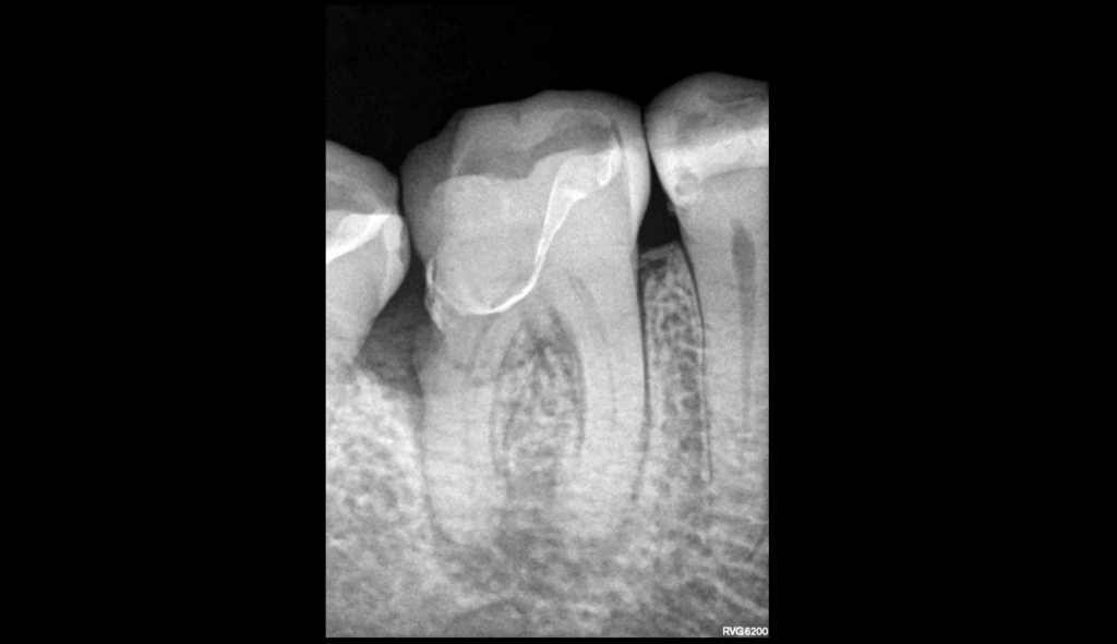 DR Brice Riera - Endodontie - EDTM Paris - Lésion endo-parodontale vraie