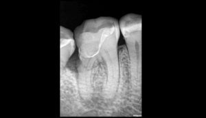 DR Brice Riera - Endodontie - EDTM Paris - Lésion endo-parodontale vraie