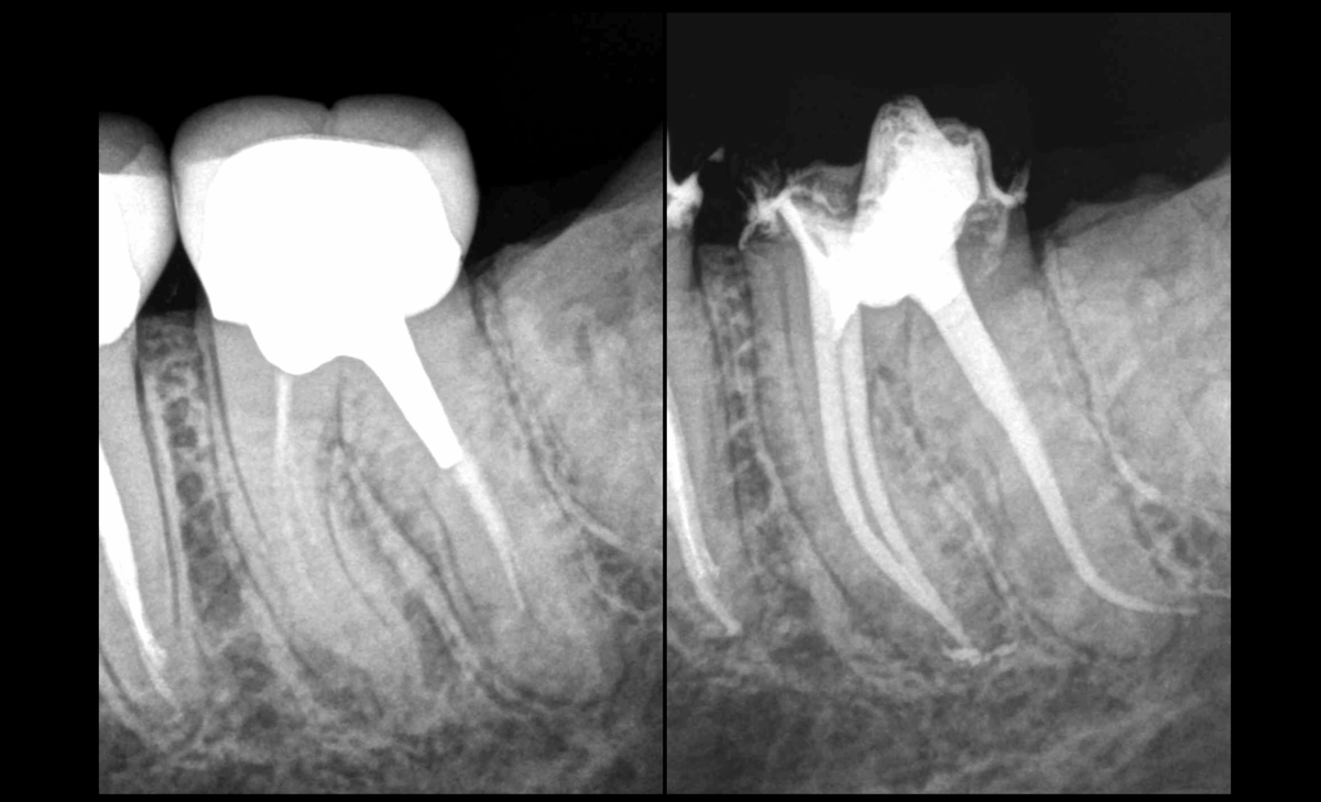 BLOG - Dr BRice RIera - Endodontie - pourquoi traitement endodontique et non avulson
