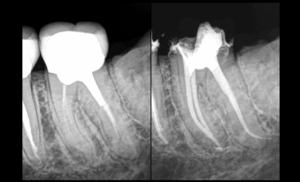 BLOG - Dr BRice RIera - Endodontie - pourquoi traitement endodontique et non avulson