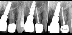 BLOG - Dr BRice Riera - Endodontie - contamination implant