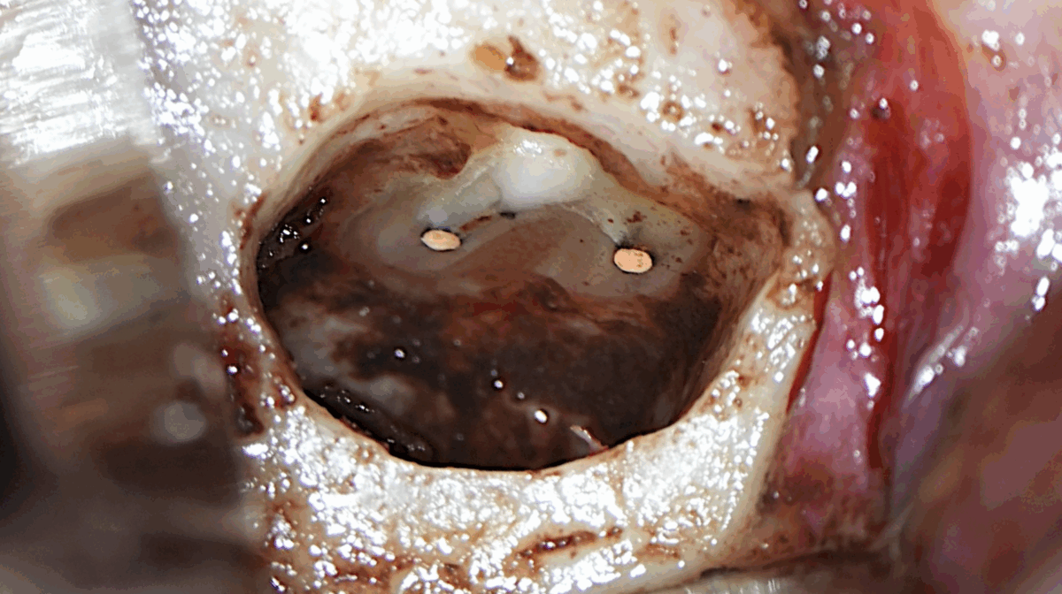 BLOG - Dr Brice RIERA - EDTM Paris 17 - revelation isthme endodontie