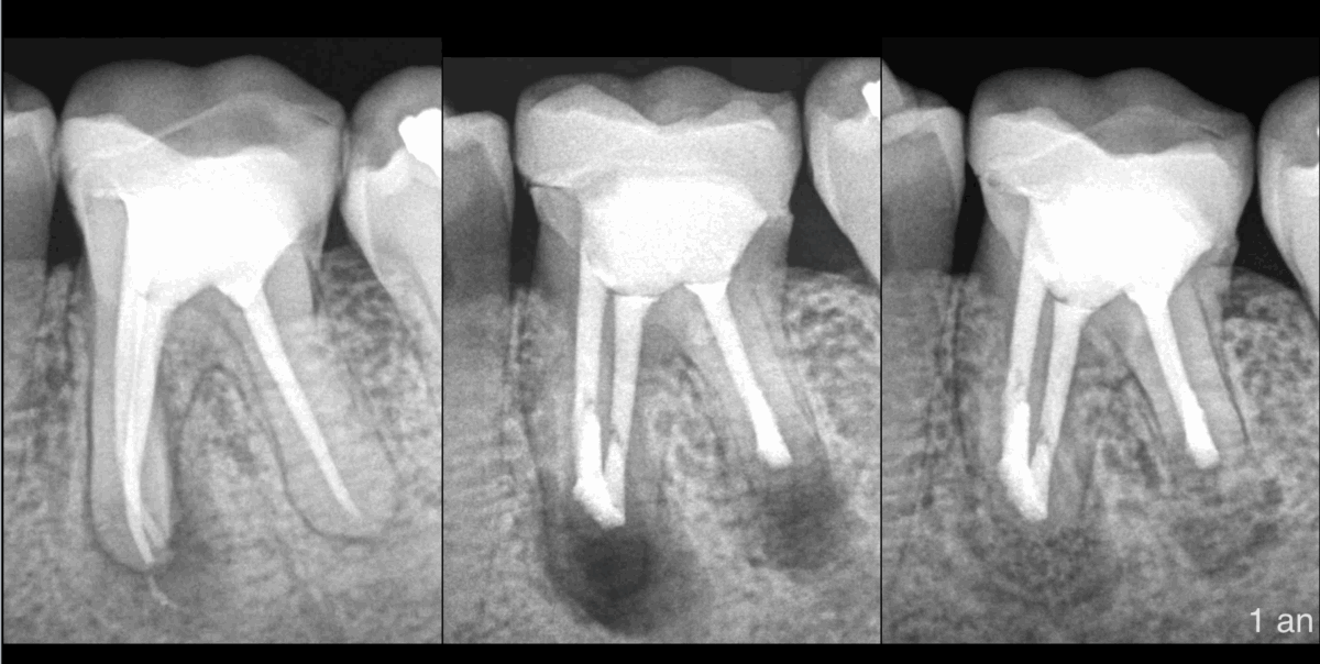 BLOG - Dr Brice RIera - Endodontie et decision therapeutique