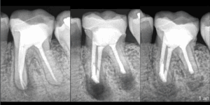 BLOG - Dr Brice RIera - Endodontie et decision therapeutique