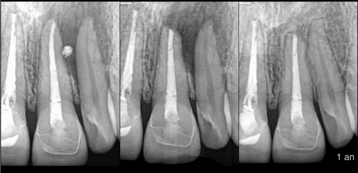 BLOG - Dr Brice Riera - Endodontie - 5 points a retenir sur cette 21