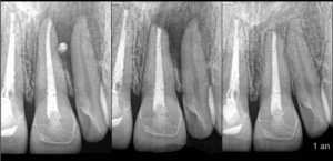 BLOG - Dr Brice Riera - Endodontie - 5 points a retenir sur cette 21