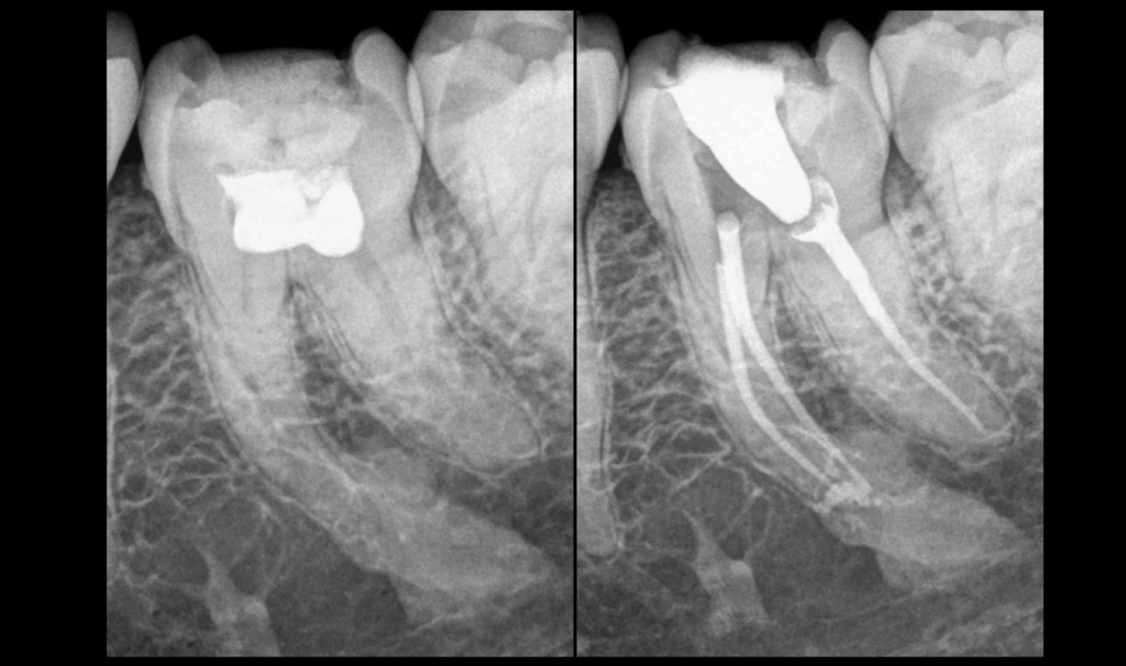 BLOG - Dr Brice Riera - Endodontie - Osteite condensante