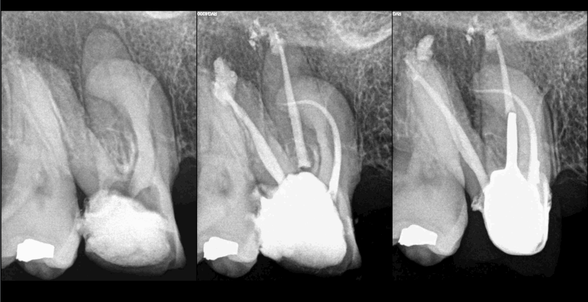 BLOG - Dr Brice Riera - Endodontie - cas parodontite apicale