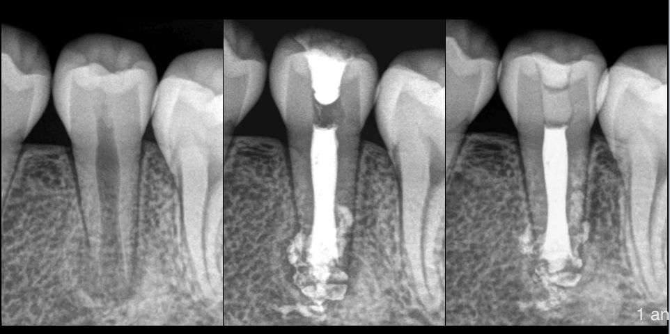 BLOG - Dr Brice Riera - Endodontie - necrose sur dent immature permanante