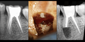 BLOG - Dr Brice Riera - Endodontiste - erreur iatrogeniques