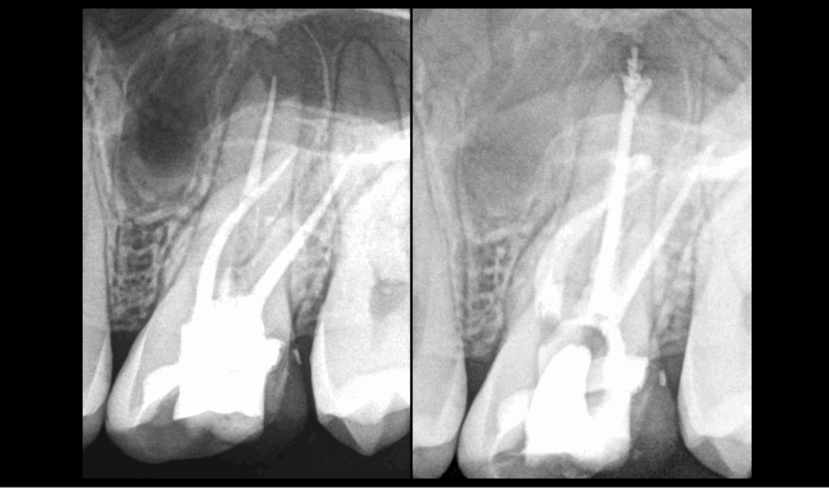 BLOG - Dr brice Riera - Endodontiste - test nouvel instrument LE SAF