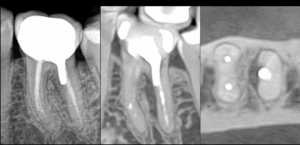 BLOG - DrBrice Riera - Endodontiste - peut on sauver cette dent