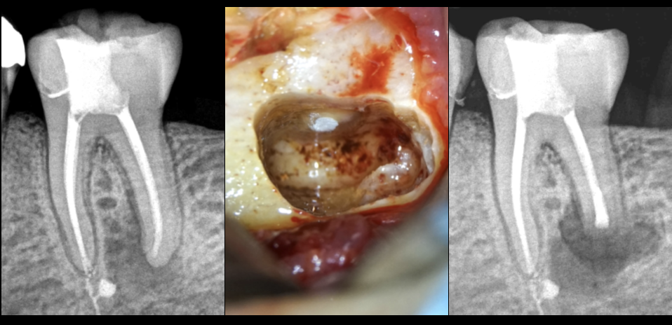 BLOG - Endodontie - Dr Brice Riera - coiffage pulpaire