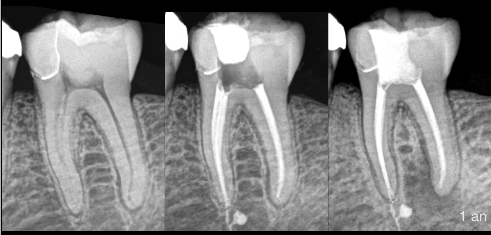 BLOG - Endodontie - Dr Brice Riera - coiffage pulpaire