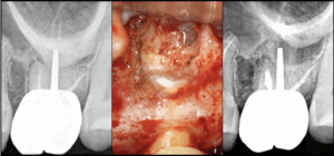 BLOG - dr brice riera - dissequer ou cureter - endodontie