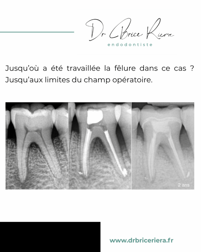 5 4 3 2 1 BLOG - Dr Brice Riera - Cas patient