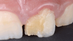 BLOG - Cas necrose pulpaire - Endodontie - Dr Brice Riera EDTM