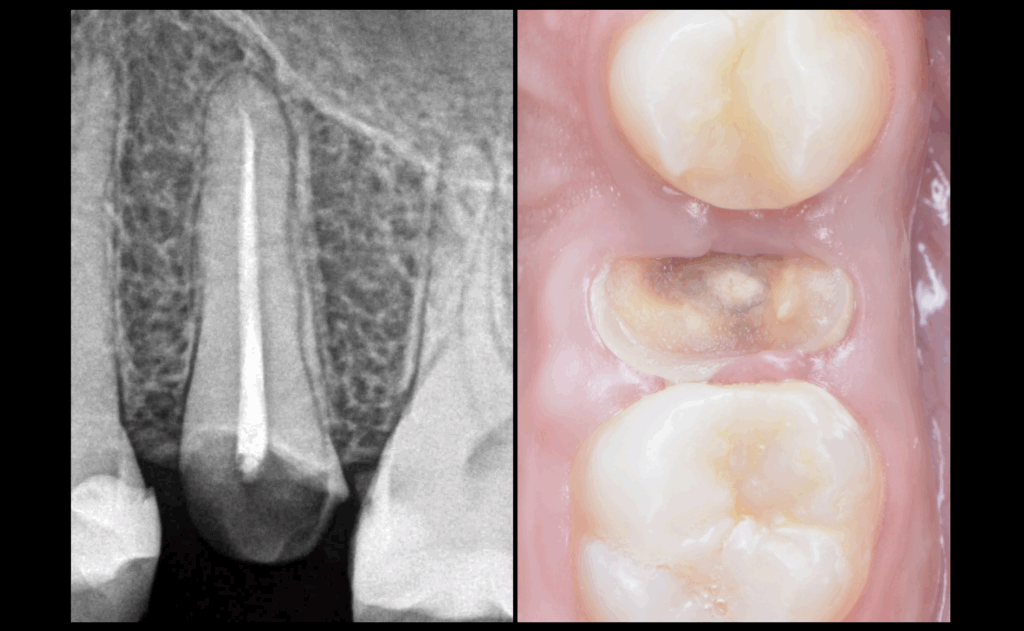 BLOG - Dr Brice RIera - endodontie - endodontie et pathologie medicale