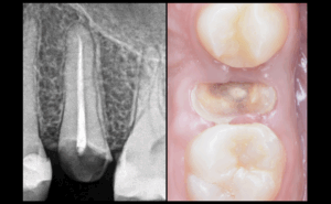 BLOG - Dr Brice RIera - endodontie - endodontie et pathologie medicale