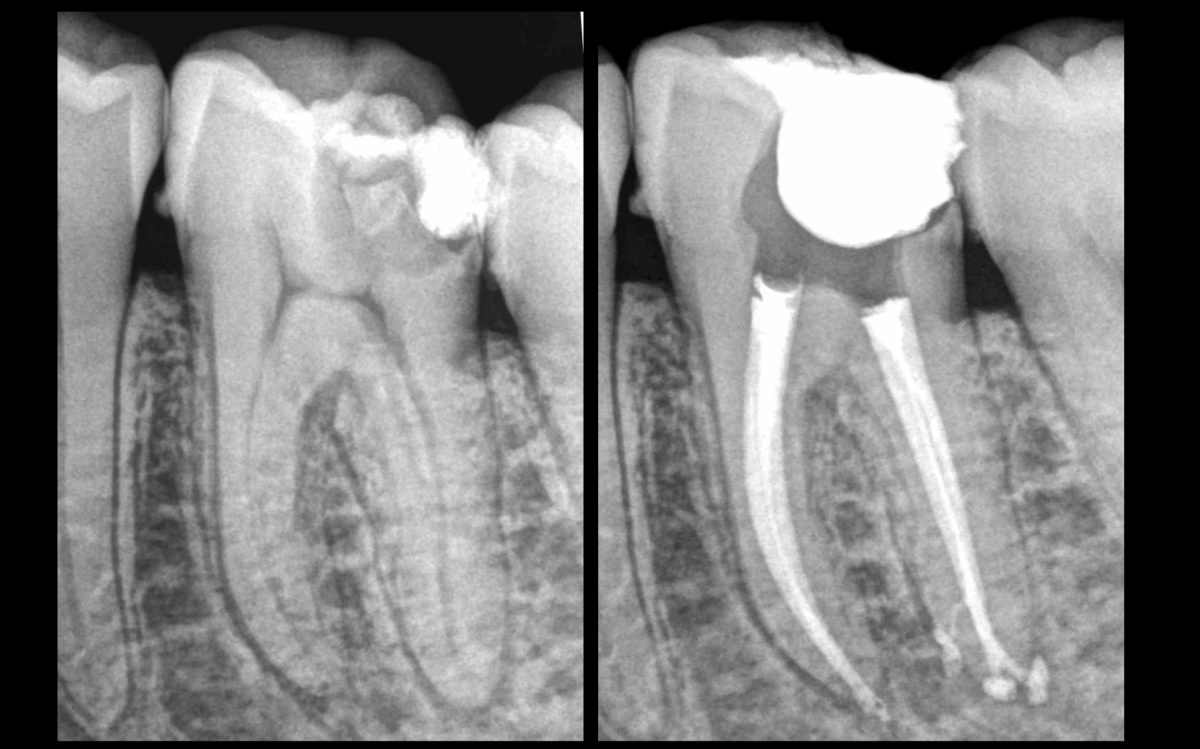 BLOG - Dr Brice Riera - Endodontie - Conicite de la dent