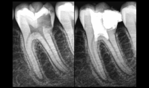 BLOG - Dr Brice Riera - Endodontie - Pulpite aigue irreversible