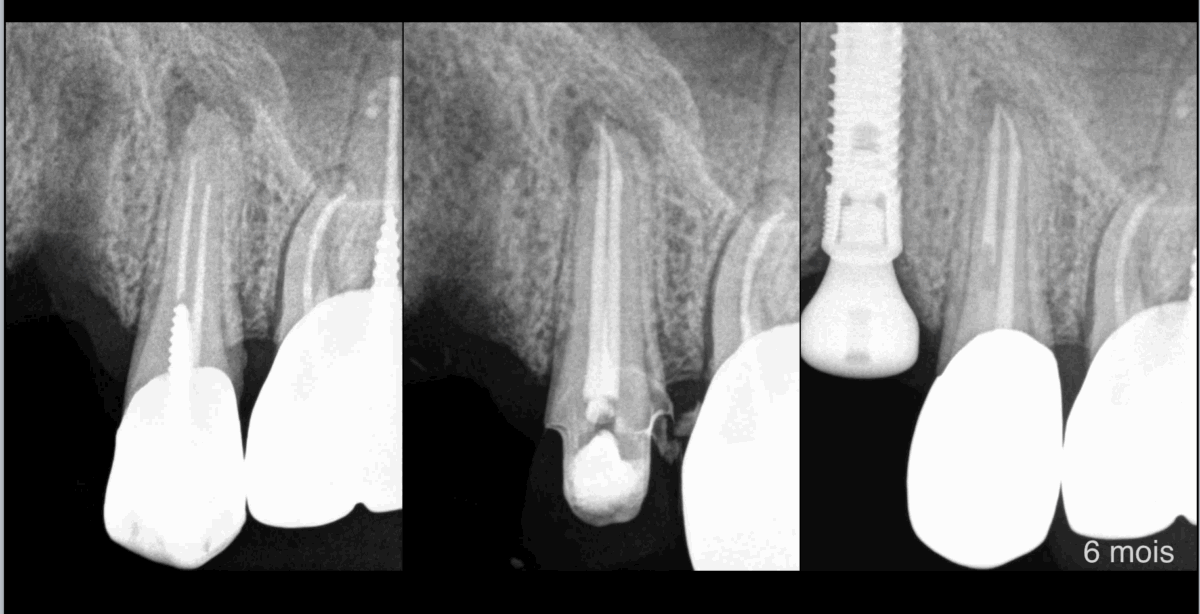 BLOG - Dr Brice Riera - Endodontie - Risque lesion apicale