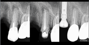 BLOG - Dr Brice Riera - Endodontie - Risque lesion apicale
