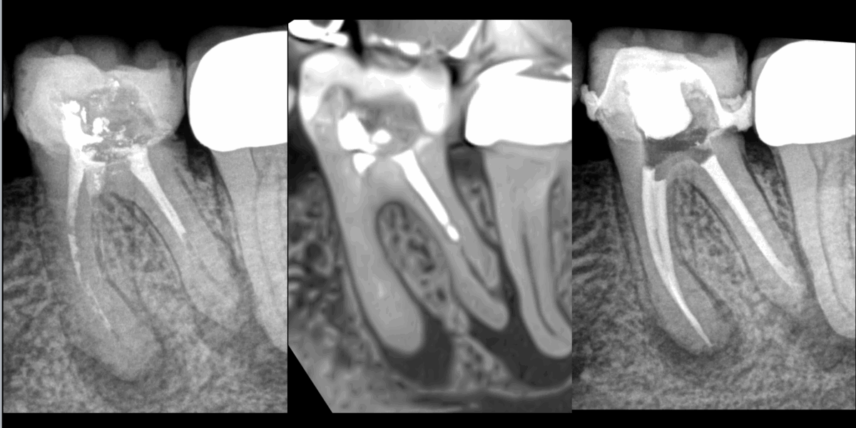 BLOG - Dr Brice Riera - Endodontie - obturation courte