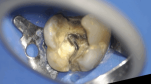 BLOG - Dr Brice Riera - Felure a penetration canalaire