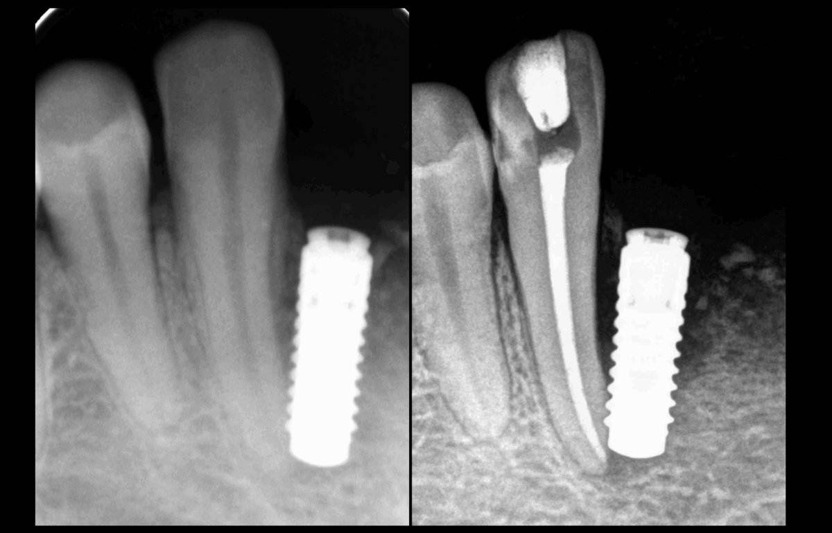 BLOG - Dr Brice Riera - Implantologie impact endodontie