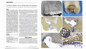 BLOG - Dr Brice Riera - lesion carieuse profonde