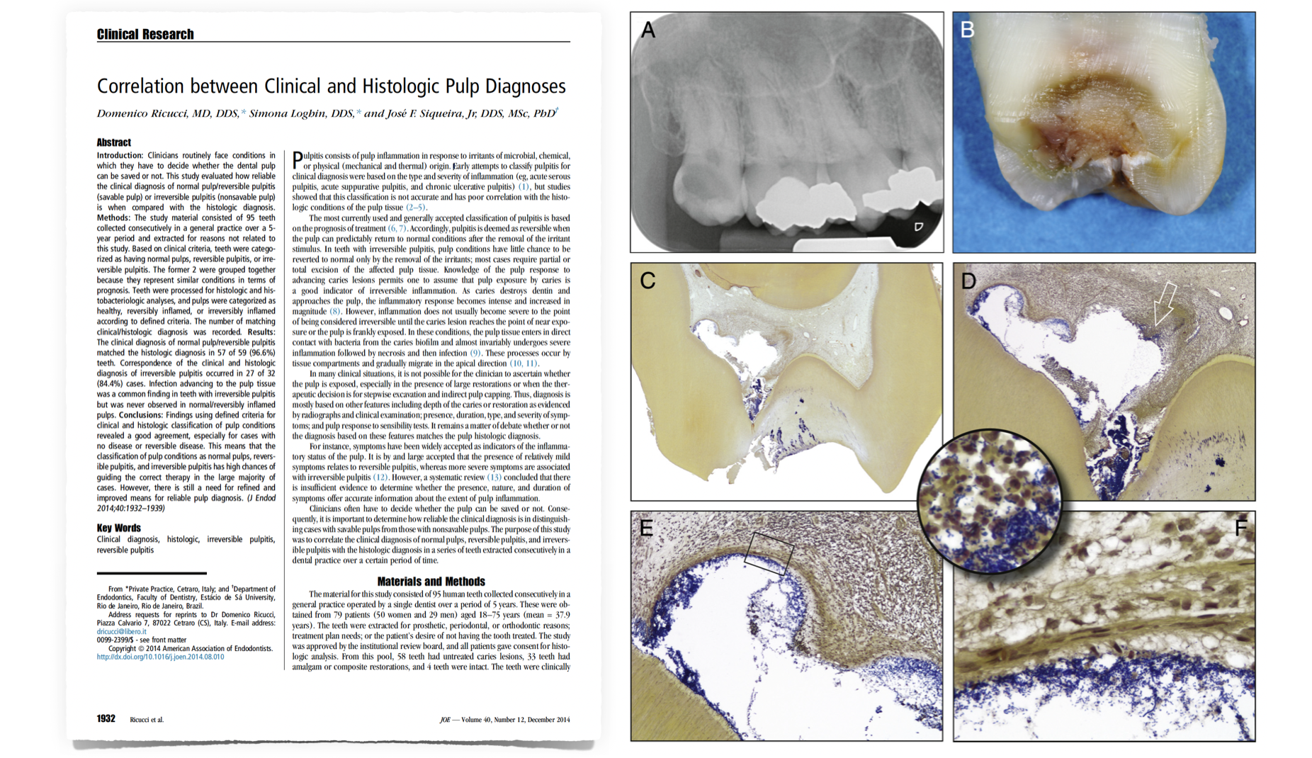 BLOG - Dr Brice Riera - lesion carieuse profonde