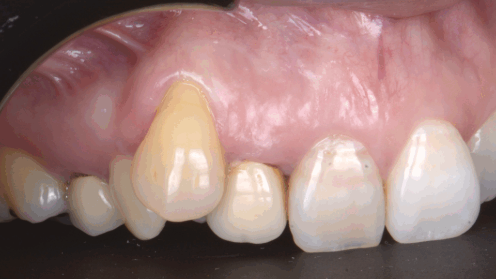 BLOG - Dr Brice Rira - Endodontie - quel serait votre trace dincision pour microchirurgie