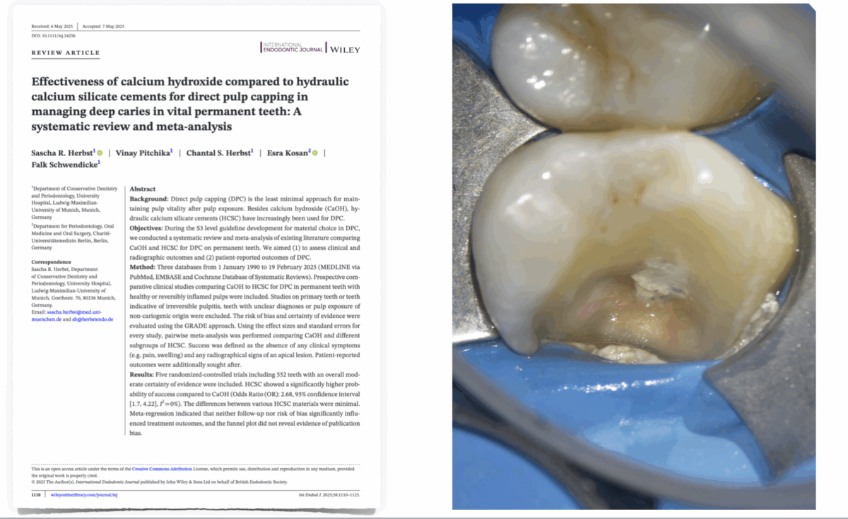 Dr Brice Riera - l’hydroxyde de calcium ou aux ciments hydrauliques à base de silicate de calcium