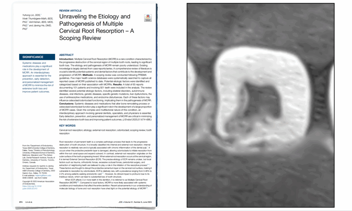 EDTM - Causes des résorptions radiculaires