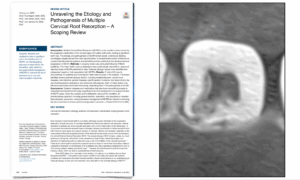 EDTM - Causes des résorptions radiculaires