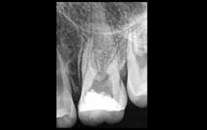 Dr Brice Riera - Endodontie - Allodynie mecanique